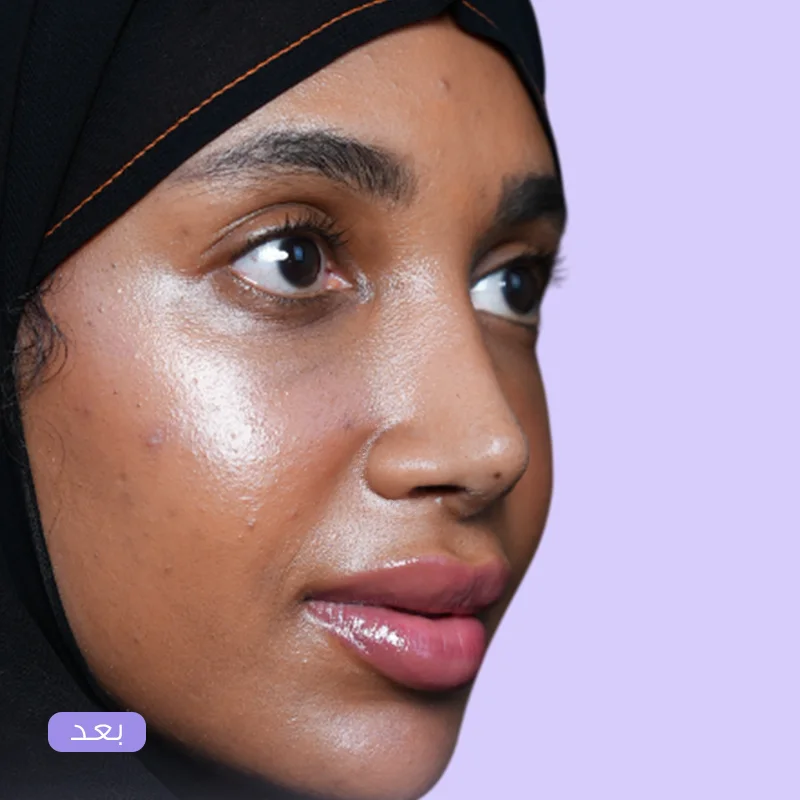 تجميل الأنف — بعد