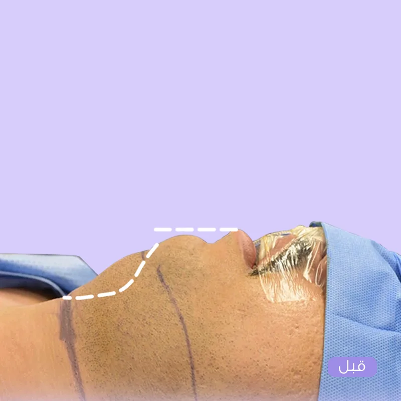 قبل شفط اللغلوغ - تراكم دهون ظاهر أسفل الذقن والرقبة