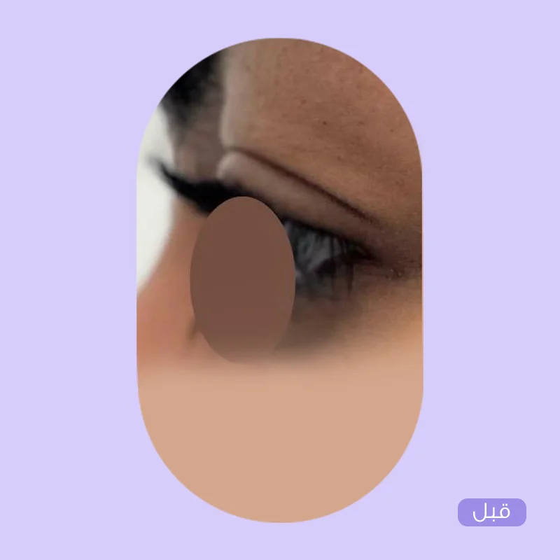 شد الجفون — قبل