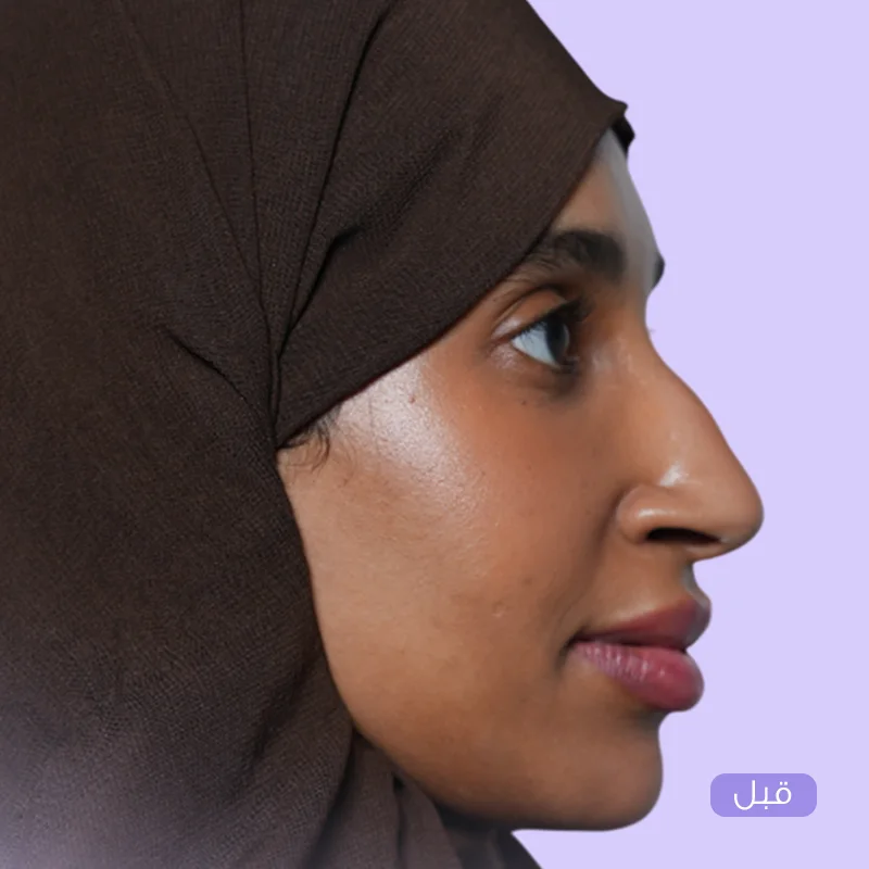 تجميل الأنف الطبيعي — قبل
