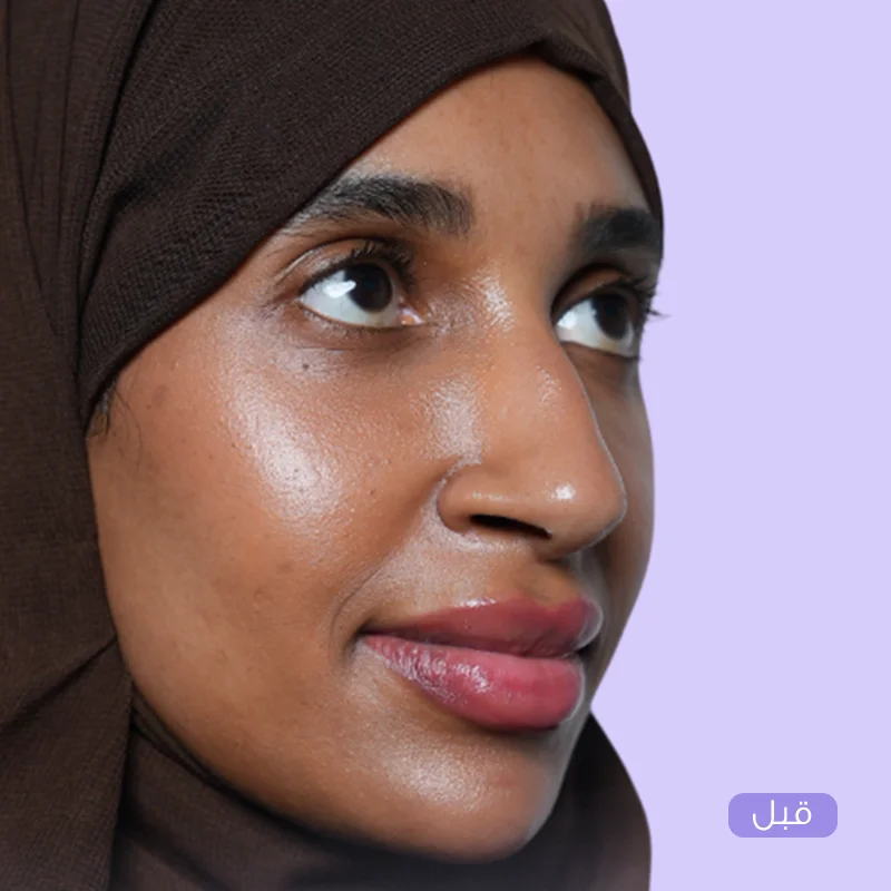 تجميل الأنف — قبل