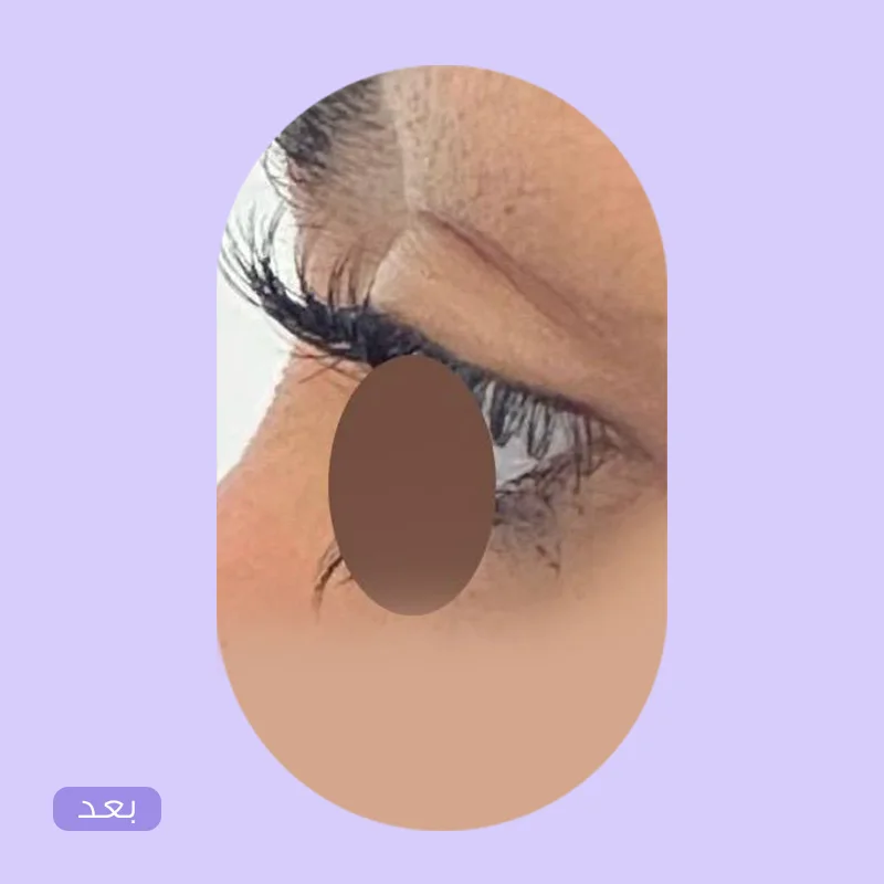 شد الجفون — بعد