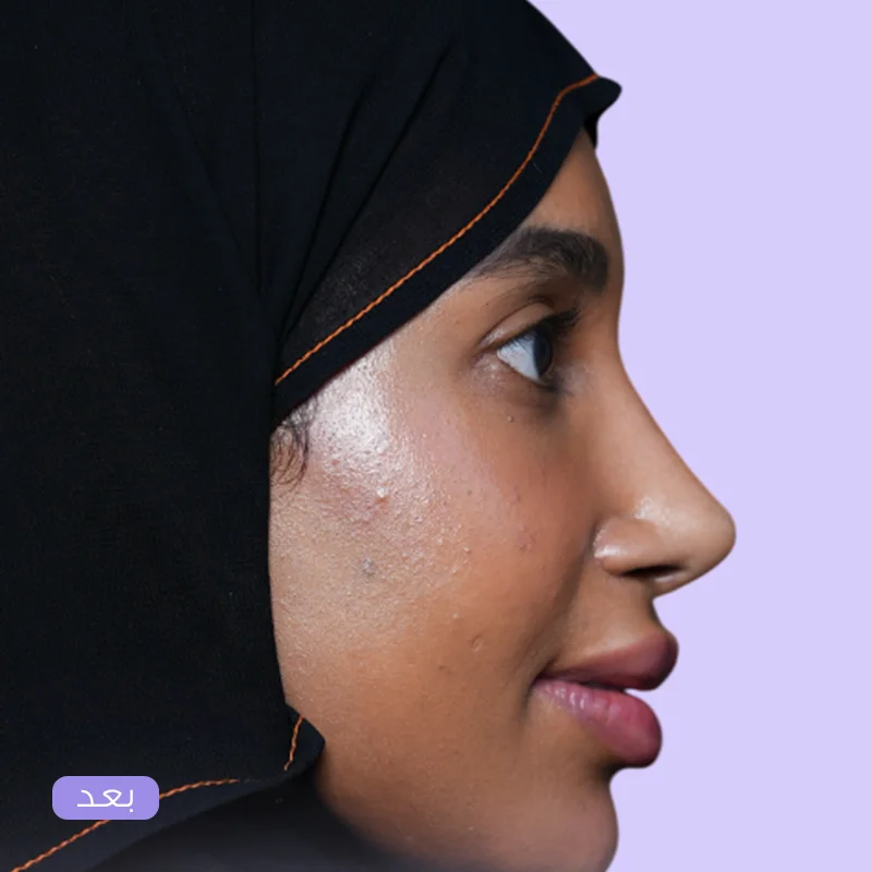 تجميل الأنف الطبيعي — بعد