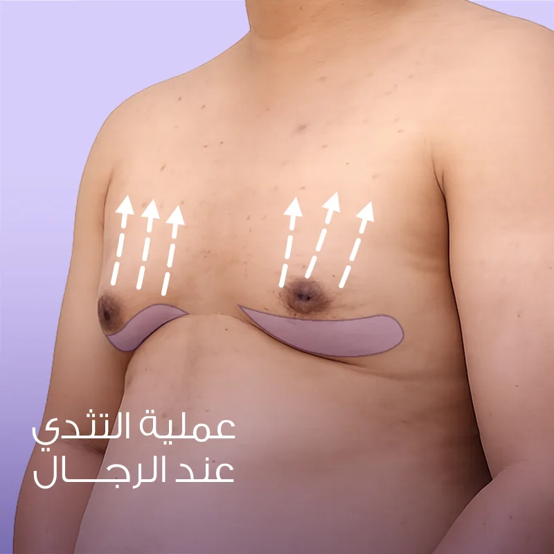 عملية التثدي عند الرجال