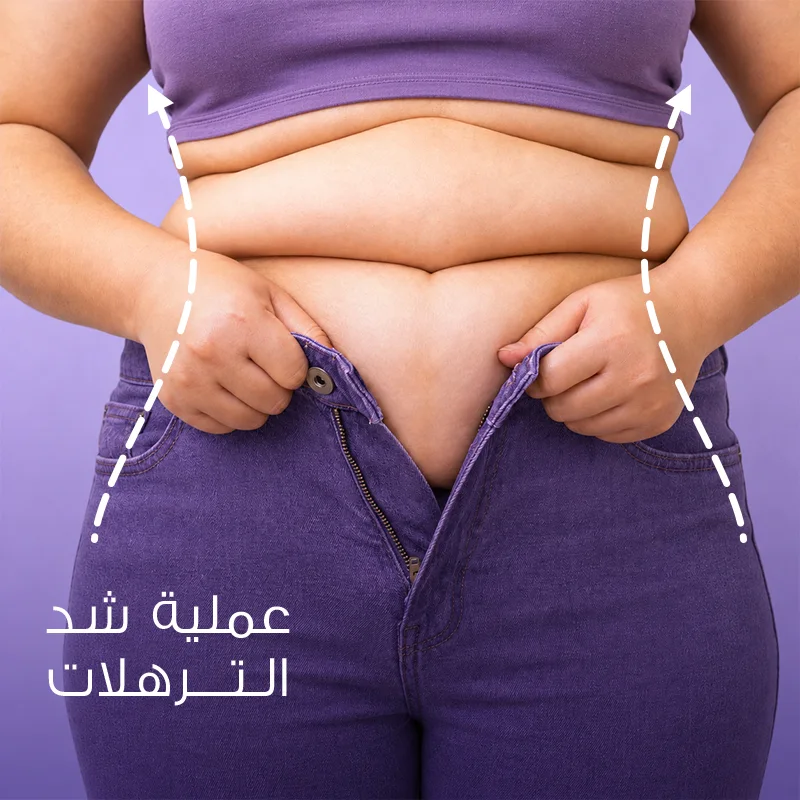 عملية شد الترهلات
